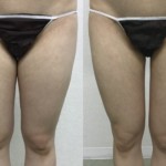 大腿内側の脂肪吸引