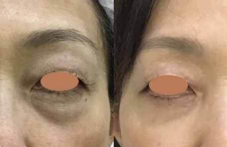 下眼瞼切開