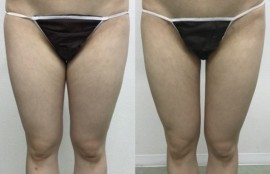 大腿内側の脂肪吸引