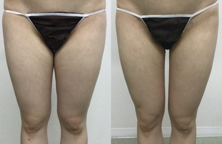 大腿内側の脂肪吸引