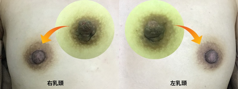 乳頭縮小術