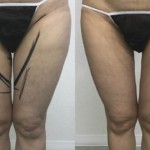 大腿内側の脂肪吸引