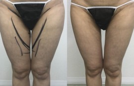 大腿内側の脂肪吸引