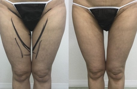 大腿内側の脂肪吸引