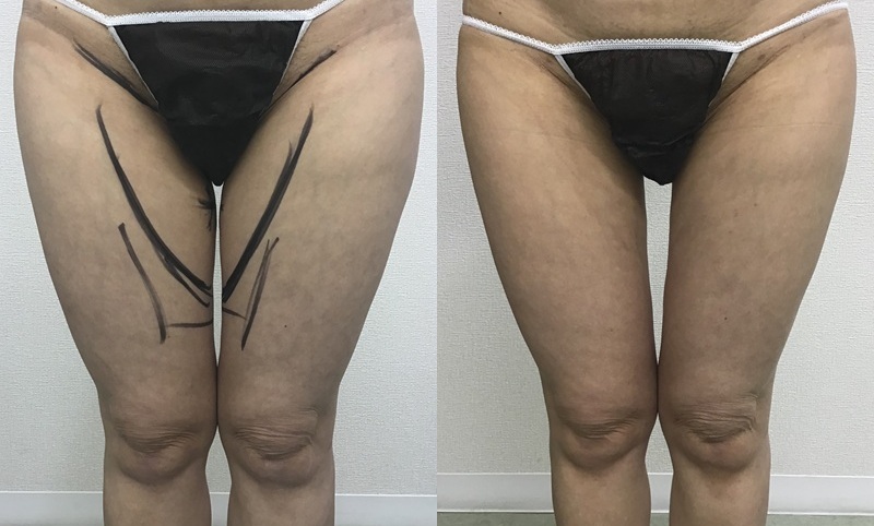 大腿内側の脂肪吸引