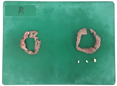 切除した乳頭およびモントゴメリー腺