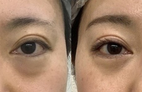 下眼瞼切開
